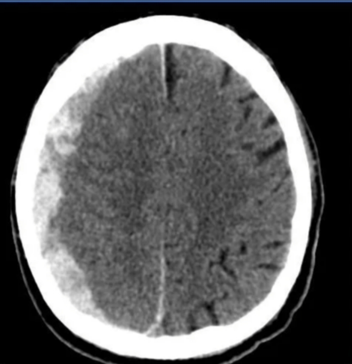 Tomografia de crânio mostrando hematoma subdural em formato de crescente